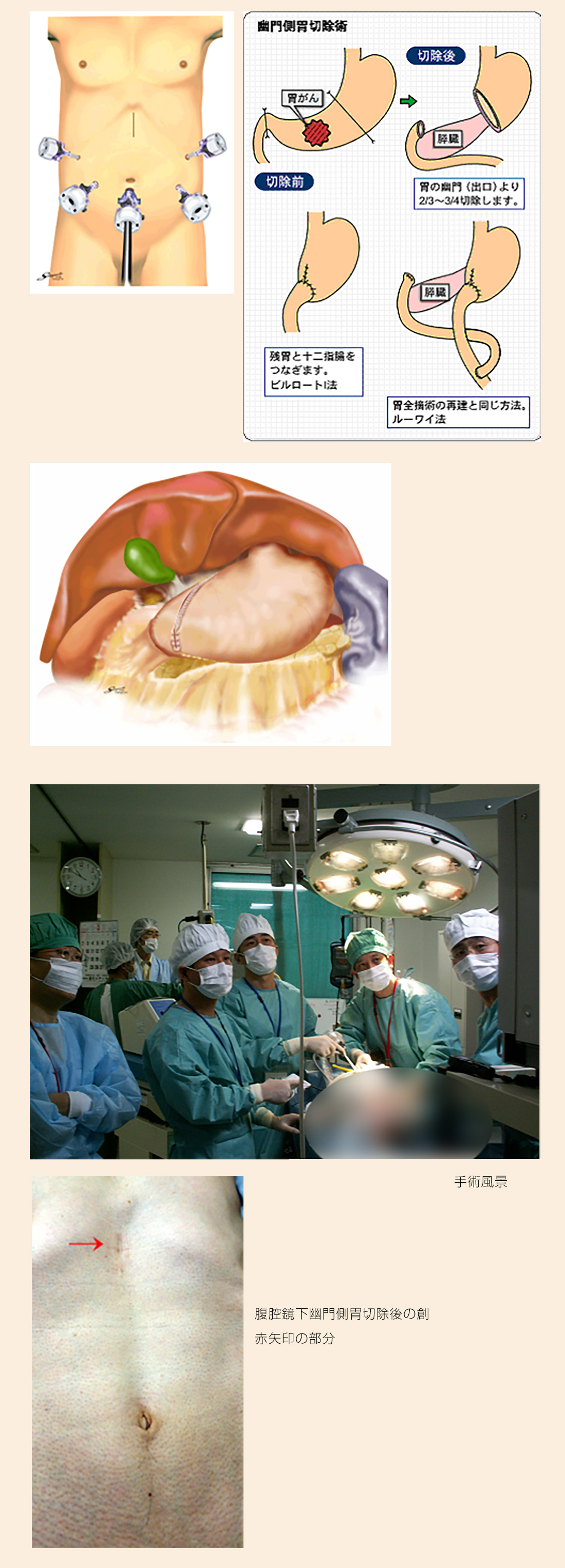 腹腔鏡下幽門側胃切除術