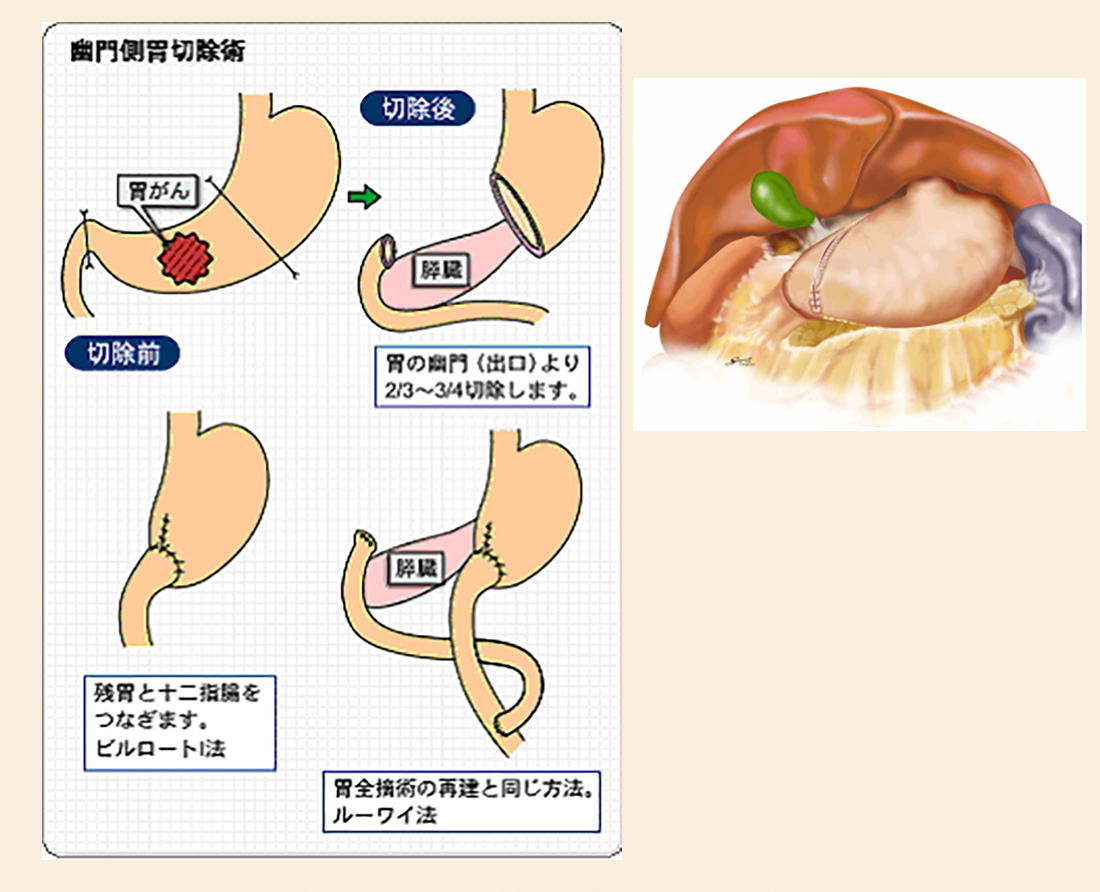 腹腔鏡下幽門側胃切除術