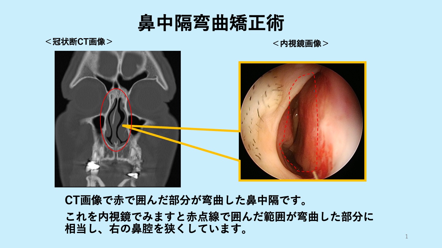 鼻中隔弯曲症の手術