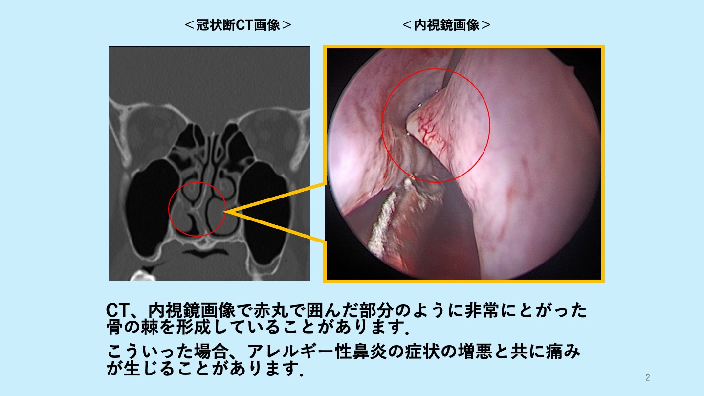 鼻中隔弯曲症の手術