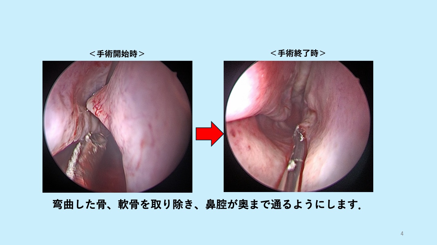 鼻中隔弯曲症の手術