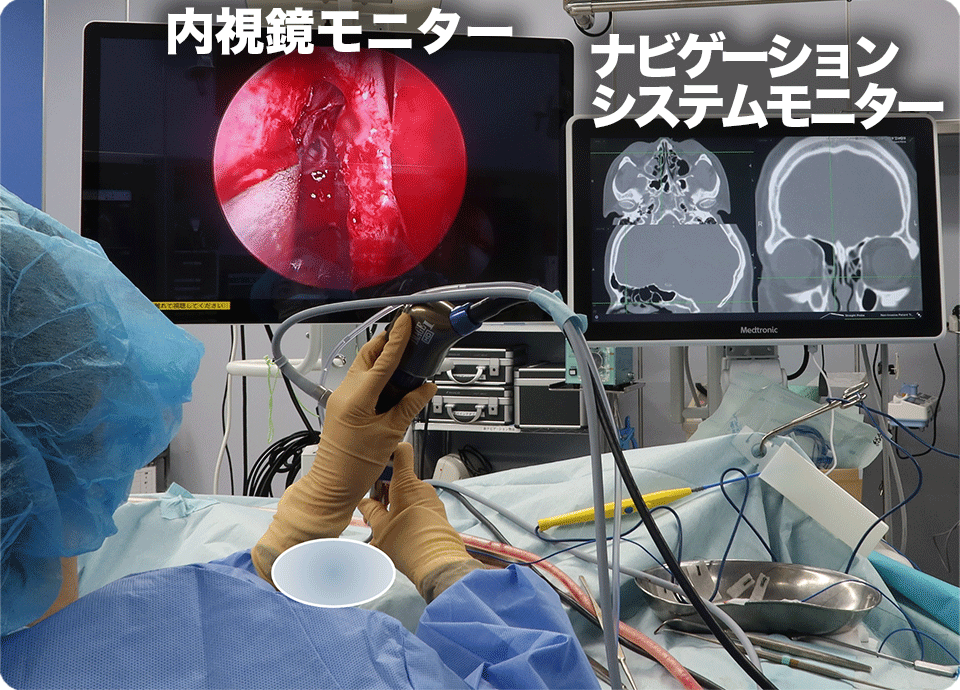 内視鏡による手術