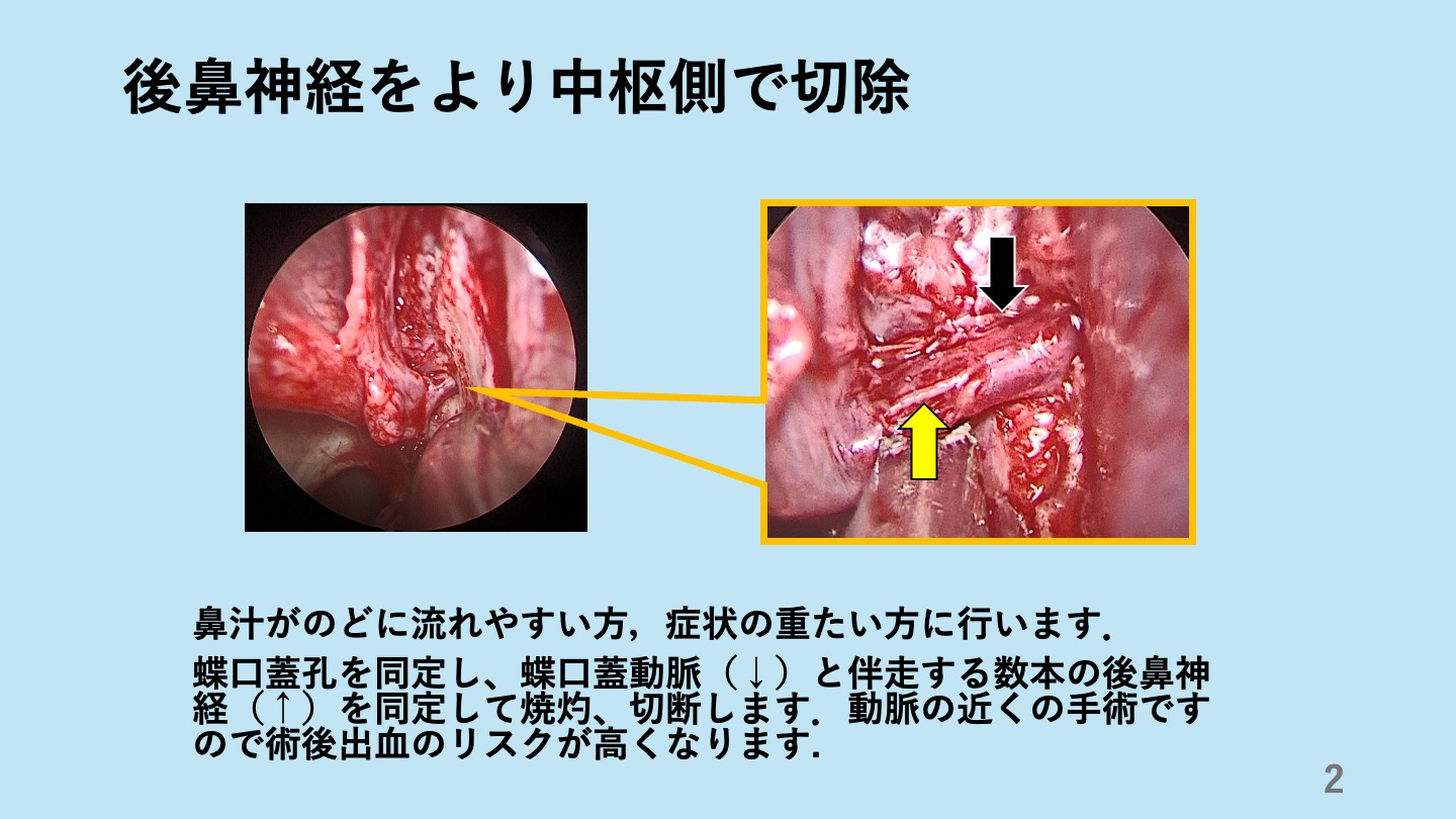 アレルギー性鼻炎の手術