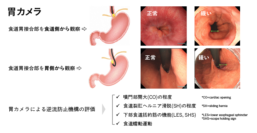 胃カメラ