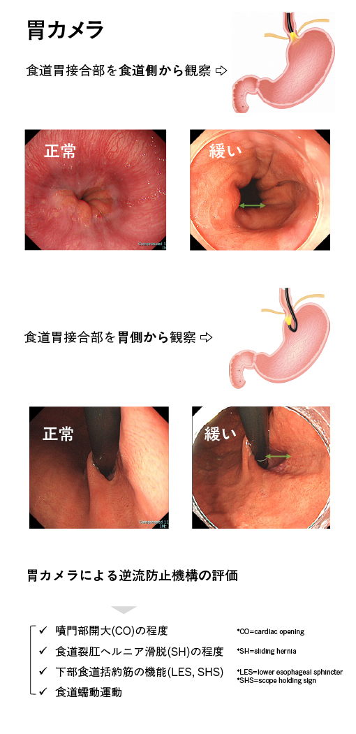胃カメラ